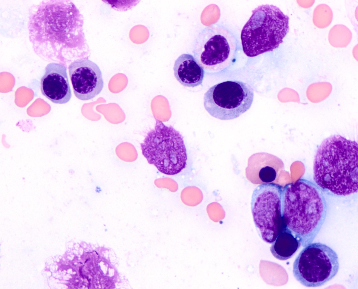 Aspirate shows increased erythroid precursors, blasts, and a dysplastic myeloid precursor (Wright-Giemsa, 1000x)